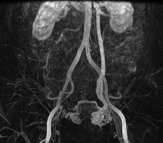 Pelvic congestion syndrome  Radiology Reference Article