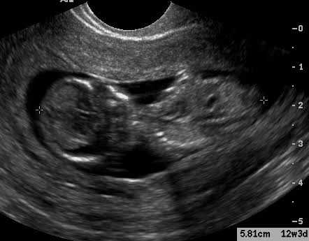 Pelvic sonogram - hromcove