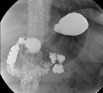 Xray Of The Upper Gastrointestinal Series Ugi With Barium