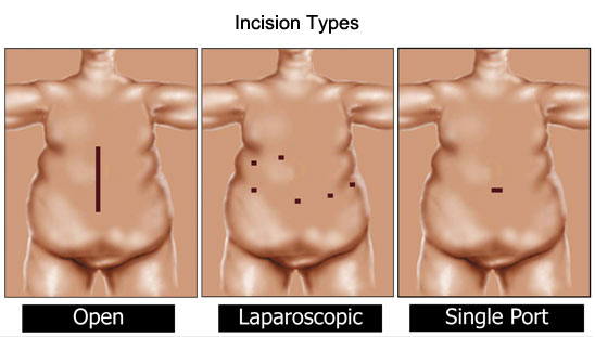 incision types