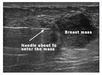 Breast ultrasound 2