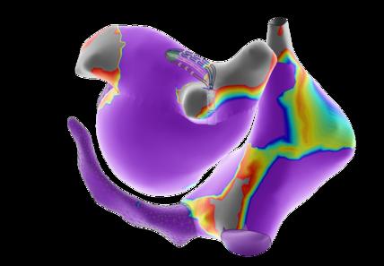 3d Heart Mapping At St. Elizabeth's