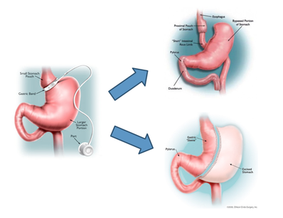 Converting a Gastric Band to a Laparoscopic Gastric Bypass of Sleeve Gastrectomy