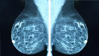 Mammogram image