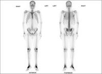 Bone scan: What does it show?