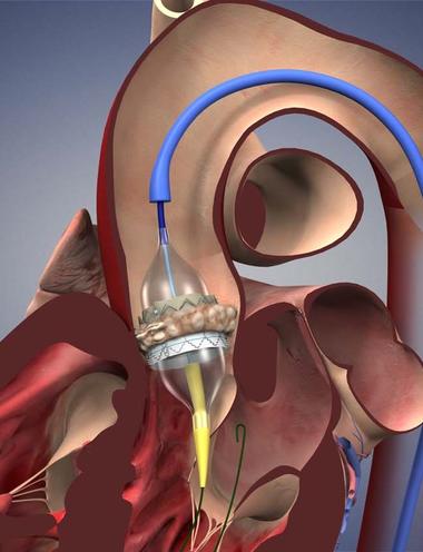 TAVR: Rockledge Regional Medical Center | A Steward Hospital | Rockledge FL